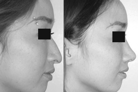 隆鼻 隆鼻是一种手术性手段，旨在改善鼻子乃至面部的美容外观。